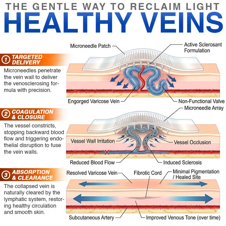 CareBreeze® Varicose Veins Treatment Microneedle Patch