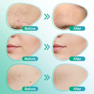 CareBreeze® 3-in-1 Scar Removal Microneedle Care Patch 💡