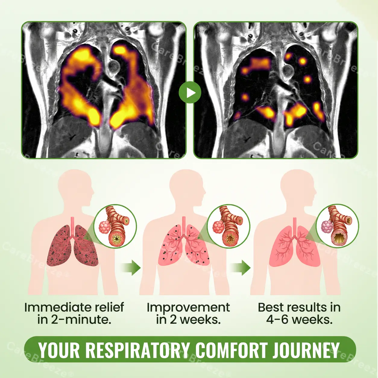 💖🇺🇸 ✅CareBreeze® Advanced Botanical Mullein Lung Cleanse Melt Strips(👨⚕️Directly acts on COPD, asthma, chronic bronchitis (CB), respiratory infections, lung cancer, sinusitis, and other conditions)