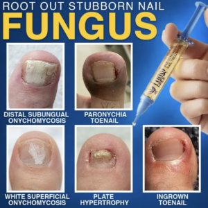 Alternative view of CareBreeze® FungiFree Bee Venom Nail Treatment