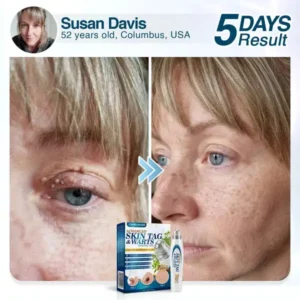 🇺🇸 CareBreeze® Advanced Skin Tag & Wart Removal Roller 🧑🏼‍⚕️