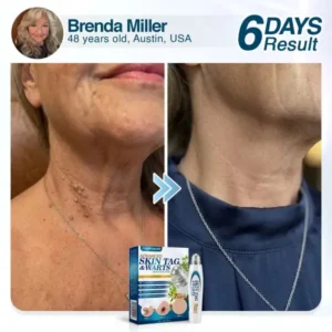 🇺🇸 CareBreeze® Advanced Skin Tag & Wart Removal Roller 🧑🏼‍⚕️