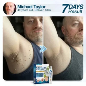 🇺🇸 CareBreeze® Advanced Skin Tag & Wart Removal Roller 🧑🏼‍⚕️