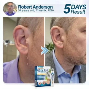 🇺🇸 CareBreeze® Advanced Skin Tag & Wart Removal Roller 🧑🏼‍⚕️