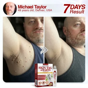 🇺🇸 CareBreeze® Herbal Skin Tag & Wart Removal Roller 🧑🏼‍⚕️