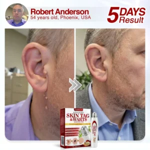 🇺🇸 CareBreeze® Herbal Skin Tag & Wart Removal Roller 🧑🏼‍⚕️